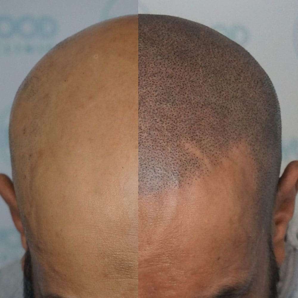 Micro Haar Pigmentatie Amsterdam