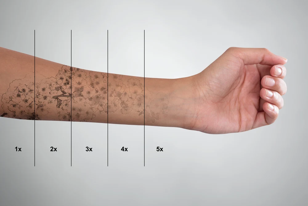 Tattoo verwijderen sessies