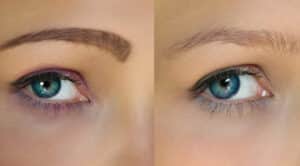 Permanente make up verwijderen door laser