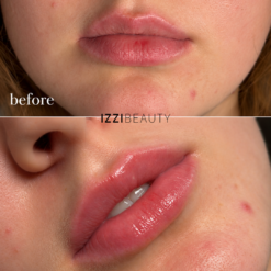 Lip Booster Treatment before & After - Online Training including Certificate